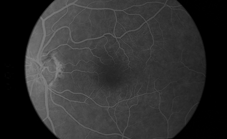 Flourescein angiogram - with white dye highlighting retinal blood vessels