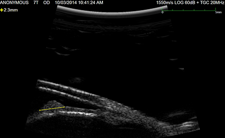 Ultrasound of an iris tumour